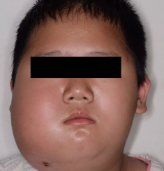  脸颊异常肿胀千万别忽视，11岁少年“误诊”两年终治愈